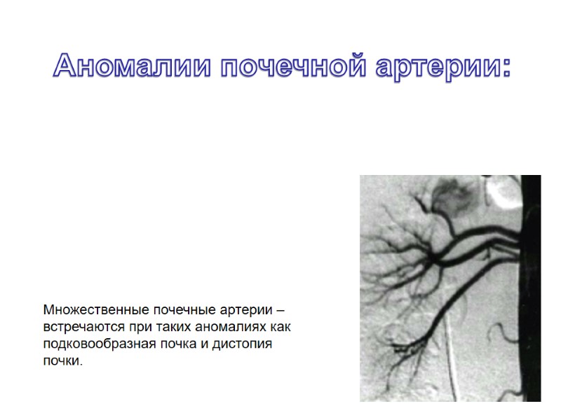 Множественные почечные артерии – встречаются при таких аномалиях как подковообразная почка и дистопия почки.